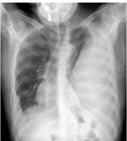 Fig. 2. Huge loculated effusion and parietal pleural thickening  in left lung.