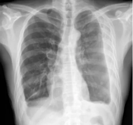 Fig. 4. Chest X-ray on day before discharge. 