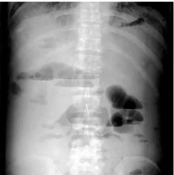 Fig. 2. Two days after the use of neostigmine and polyethylene gly- gly-col electrolyte solution, plain abdomen (upright film) shows only colonic gas without an air-fluid level.
