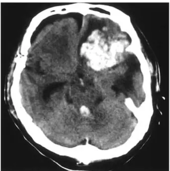 Fig. 3. Left internal carotid artery angiogram in lateral projection, showing direct CCF with drainage into sigmoid sinus (short arrow), superior ophthalmic vein (long arrow) and inferior ophthalmic vein (arrowhead), and dilated subfrontal pial veins (open