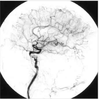 Fig. 4. Follow-up angiogram after the transarterial embolization shows a complete occlusion of CCF.