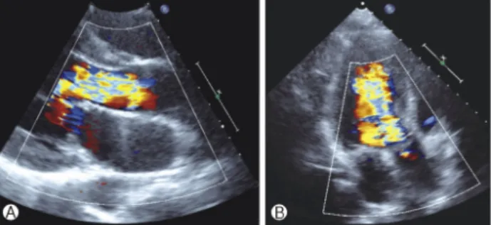 Fig. 2. Multifocal tumors in VHL disease. Contrast enhanced  computed tomography shows well-enhanced both adrenal  pheo-chromocytomas (A, white arrows), strong enhancing hepatic he-  mangioma in S2 segment of liver (B, white arrow) and right renal cell car