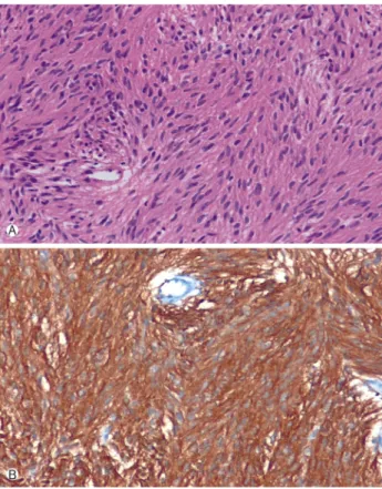 Fig. 2. Abdominal contrast enhanced CT scan revealed that mul- mul-tiple soft tissue masses were occupying entire peritoneal cavity.