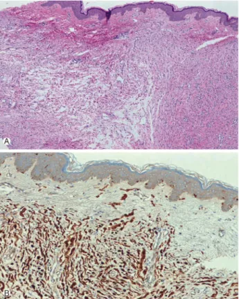 Fig. 4. Microscopic findings of the skin. (A) Spindle cells with  elongated and wavy nuclei are present in the dermis (H&amp;E stain,
