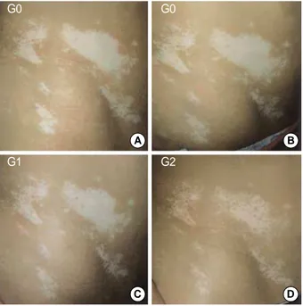 Fig. 1. Vitiligo patches on the left side of the trunk (A) prior to the 308-nm excimer laser treatment, (B) at 5 treatments, (C) at 15  treat-ments, and (D) at 20 treatments (G: repigmentation grade).