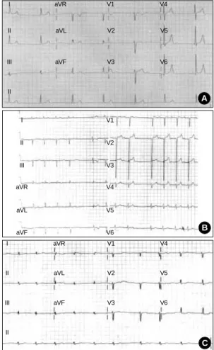 Fig. 3. 12-lead ECG of EDMD (A), AD EDMD2 (B) and LGMD1B (C). (A) The ECG shows sinus arrest with junctional escape rhythm at a heart rate of 40 beats per minute
