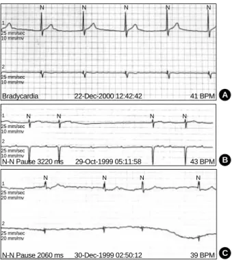 Fig. 5. Findings of electrophysiologic study in a patient with XR EDMD (case 1). Electrophysiologic study shows no electrical  sig-nal in the right upper atrium