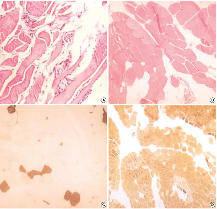 Fig. 6. The histopathologic findings of skeletal muscle biopsy specimen in AD EDMD2 (A) and LGMD1B (B-D) patient
