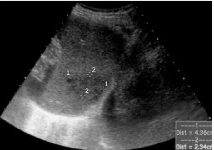 Fig. 2. Abdominal CT reveals multiple septated cystic lesion in the spleen, the largest 4.3 cm, compatible with multiple splenic abscesses.