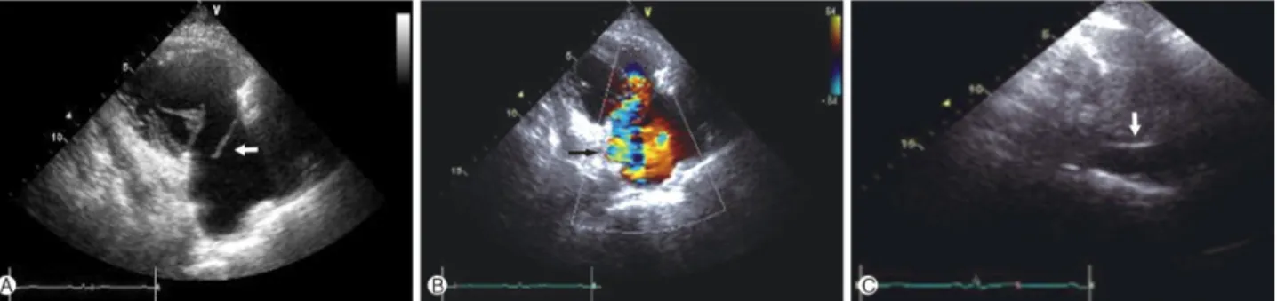 Fig. 3. The cardiac computed tomography shows chordae tendi- tendi-neae rupture with the prolapsed of the anterior leaflet (black  arrow).