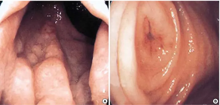 Fig. 1. Colonoscopic findings at admission. (A) Colonoscopy showing granular &amp; reddish mucosal thickening in the rectum just above anus.