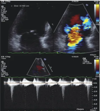 Fig. 2. Transthoracic echocardiography shows mild mitral regur-  gitation in asymptomatic status.