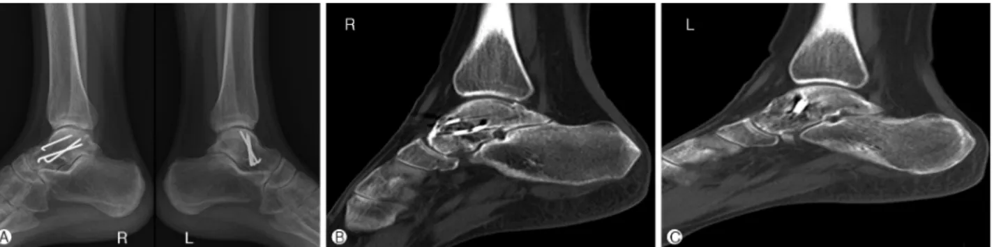 Fig. 4. Twelve months follow-up. (A) Radiographs and (B), (C) CT show bony union without other complications.