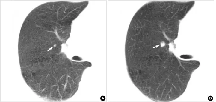 Fig. 2. A 65-yr-old man with squamous cell carcinoma. (A) Lung window of initial screening low-dose CT (5-mm collimation) scan obtained at level of bronchus intermedius shows 5-mm-sized nodule (arrow) in bottom of anterior segment of right upper lobe