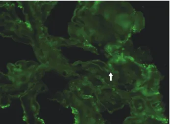 Fig. 2. Immunofluorescent staining shows diffuse linear and partly granular peripheral straining of IgG is bound to the glomerular basement membrane (arrow).
