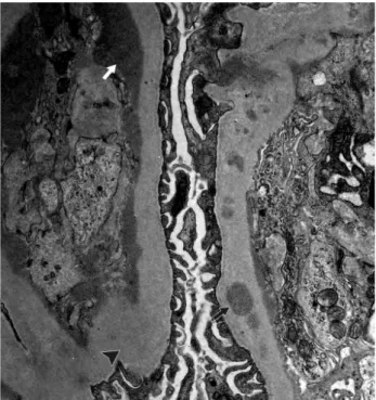 Fig. 3. Electron microscopy shows massive subendothelial depo- depo-sits (white arrow) and subepithelial and intramembranous depodepo-sits (black arrow)
