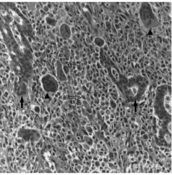 Fig. 2. Histologically, the tumor is composed of typical ductal ade- ade-nocarcinoma (closed arrow) and surrounding mononuclear  stro-mal cells (open arrow) intermingled with osteoclast-like giant cells (closed arrow head) and pleomorphic large cells (open