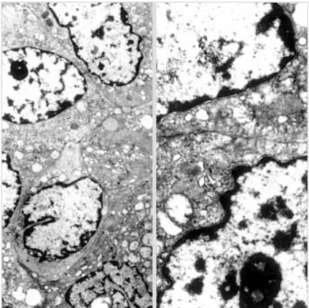 Fig. 4. Electron microscopically, the nucleus of the mononuclear cell contains prominent nucleoli, with dispersed clumps of  hetero-chromatin