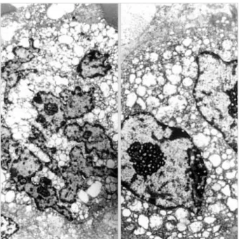 Fig. 5. Electron microscopically, osteoclast-like giant cell has mul- mul-tiple nuclei with dispersed chromatin and a fine chromatin rim