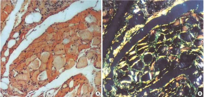 Fig. 3. Endomysial and perimysial deposition of amyloid in the iliopsoas muscle. Congo red with light microscopy (A) and with polarizing microscopy (B) (×100).