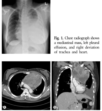 Fig. 2. (A) Contrast-enhanced CT shows a 16 cm-sized anterior mediastinal mass with heterogeneous enhancement