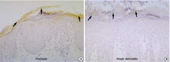 Fig. 4. Immunostaining for LL-37 in frozen skin sections from patients with psoriasis and atopic dermatitis