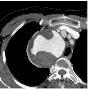 Fig. 1. PA chest roentgenogram shows well-defined, paratracheal mass of about 7 cm in the upper zone of the right hemithorax.