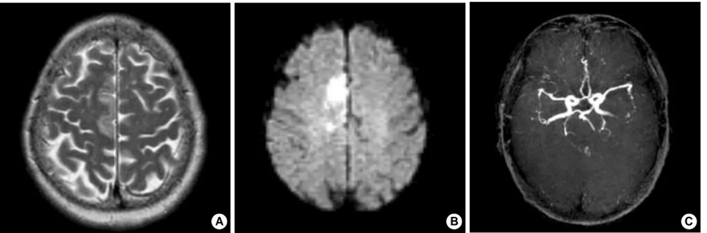 Fig. 1. T2-weighted (A) and diffusion-weighted (B) axial MRI scans show acute cerebral infarction on the callosomarginal territory of right anterior cerebral artery