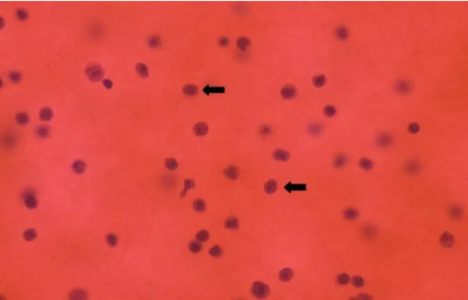 Fig. 1. Leukemic cells observed in the cerebrospinal fluid (Pap  stain, ×400).고립성 중추신경계 재발의 경우 대부분이 1년 이내에 골수 내에 재발을 동반하는 것으로 알려져 있으며, 표준 치료가 정립되어 있지 않고 예후가 좋지 않아 대부분의 환자가 결국 사망하게 된다.9,12,20저자는 급성골수성 백혈병으로 진단을 받고 동종조혈모세포이식 시행 후 12개월 째 양측 하지의 근력저하와 골반의 통증으로