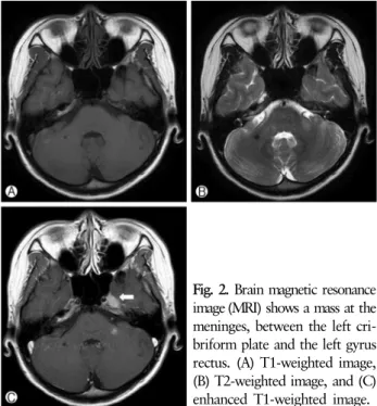 Fig. 2. Brain magnetic resonance image (MRI) shows a mass at the meninges, between the left  cri-briform plate and the left gyrus rectus