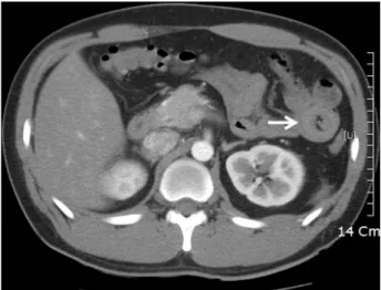 Fig. 3. A 2.5×3.0cm sized polyp  (A) shows jejunal mucosa  conta-ining hyperplastic glands and  arborizing central stalk contain-  ing smooth muscle bundles (B 