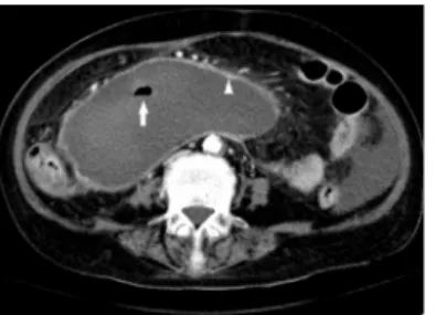 Fig. 3. Abdominal CT shows air bubble in encapsulated retroperitoneal hematoma (arrow) and rim enhance-  ment of hematoma wall  (arrow head)