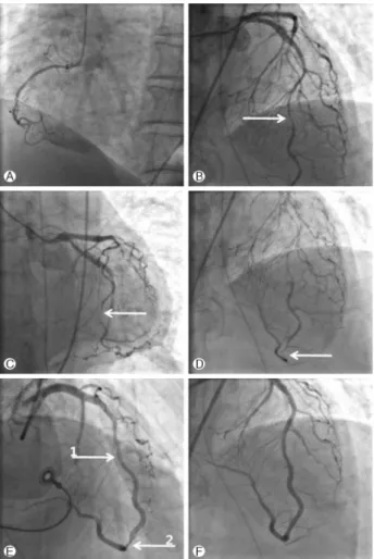 Fig. 2. The data on the coronary angiography. (A) Right coronary artery was diminutive