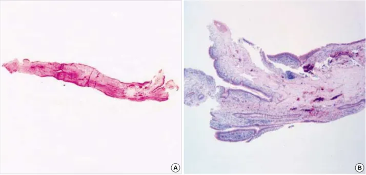 Fig. 4. Gross appearance of bronchial polyp (A) and bronchial polyp composed of lymphocytes and epithelial lining cells (B)