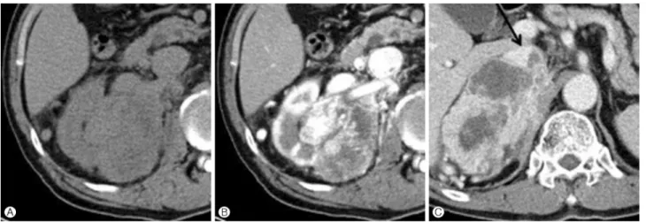 Fig. 3. A 73-year-old man with clear cell renal carcinoma. (A) Unenhanced CT scan obtained atthe level of the interpolar area of the right kidney shows a lobulated mass with an 11 cm diameter and 38 Hounsfield units and perirenal changes
