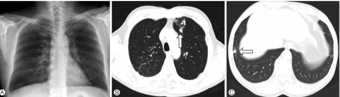 Fig. 1. Chest X-ray that shows both upper-lobe lung nodules, which are suspected of having pulmonary tuberculosis (A)