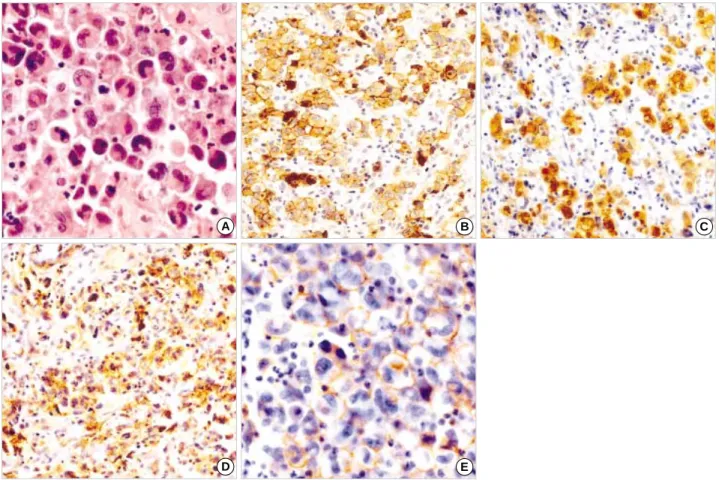 Fig. 1. (A) Anaplastic large cell lymphoma. H &amp; E stain (×400). (B) Anaplastic large cell lymphoma, CD30 expression (×100)