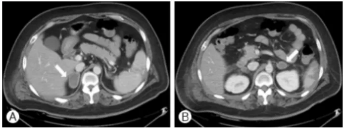 Fig. 1. Initial abdominal CT scan performed directly after blunt abdominal trauma. (A) 4 cm and (B) 2.3 cm adrenal masses  wit-hout contrast enhancement are seen.