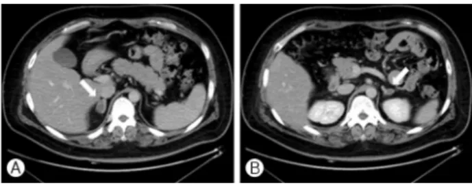 Fig. 2. Follow-up abdominal CT scan obtained 2 months later.