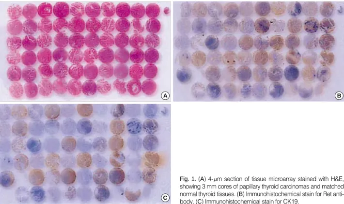 Fig. 1. (A) 4- m section of tissue microarray stained with H&amp;E, showing 3 mm cores of papillary thyroid carcinomas and matched normal thyroid tissues