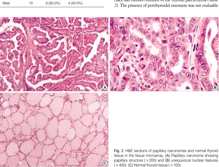 Fig. 2. H&amp;E sections of papillary carcinomas and normal thyroid tissue in the tissue microarray