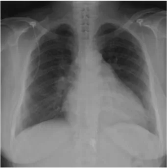 Fig. 1. A resting electrocardiogram shows left ventricular hyper- hyper-trophy with an inverted T waves in the precordial leads.