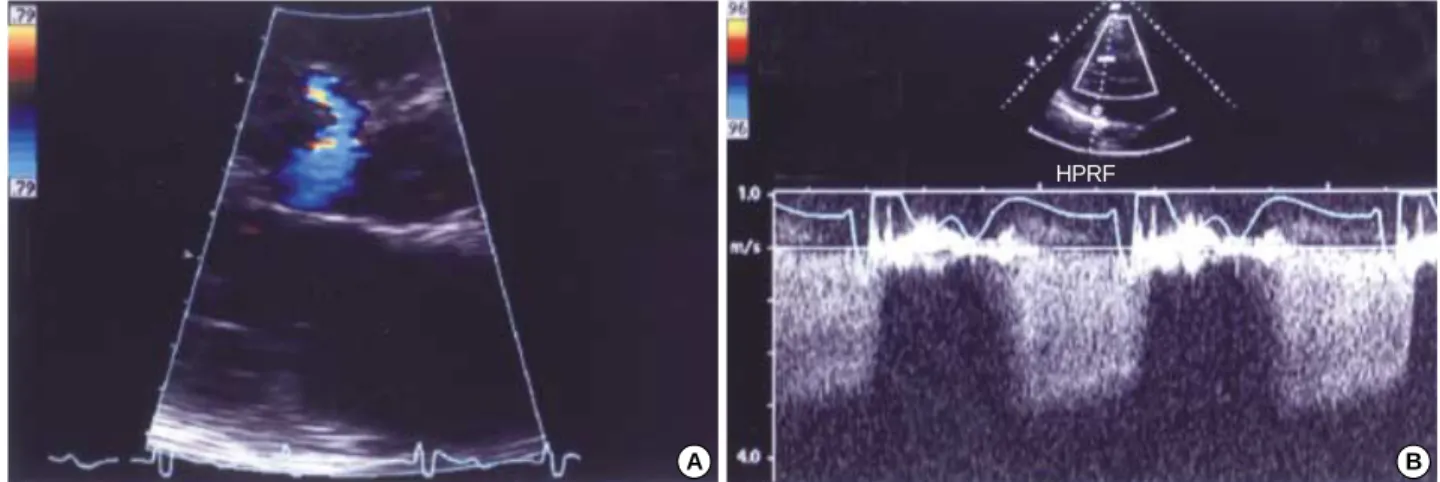 Fig. 4. In the parasternal long axis view, color Doppler examination shows the shunt flow from the septal perforators to the left ventricular cavity occurring during diastole at the myectomy site in the basal interventricular septum (A), and its peak veloc