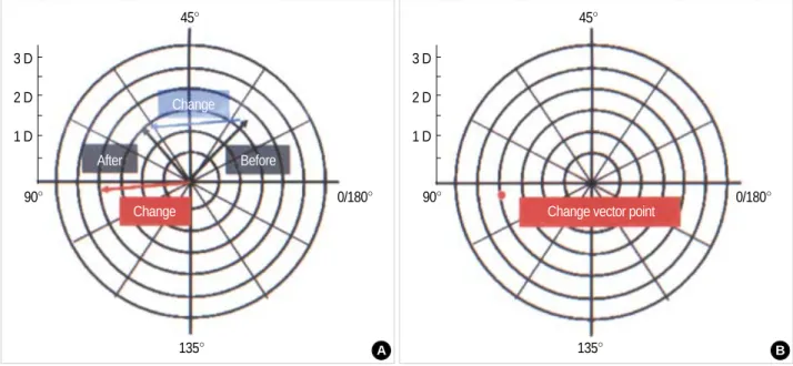 Fig. 1. Graphical method for calculating corneal astigmatism vector change. (A) If a corneal astigmatic measurement of a patient before botulinum toxin-A injection showed 1.75 diopter with its steepest axis 26 degree (right, marked as ‘‘Before) and changed