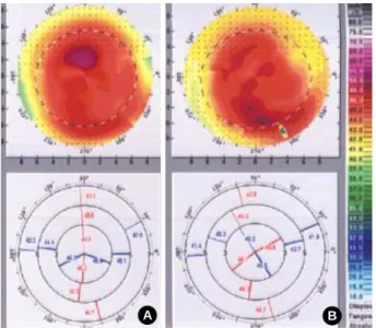 Fig. 4. The mean corneal astigmatism before and 1, 6 months after injection of botulinum toxin-A in patients with blepharospasm.