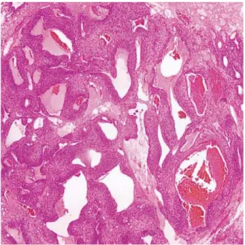 Fig. 1. A 2 cm sized, erythematous to violaceous hemispheric nod- nod-ule on the left side of lower back.