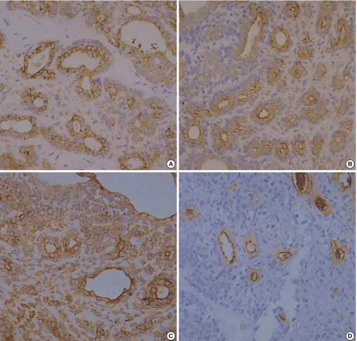 Fig. 4. Immunohistochemical staining for CK (A), CK7 (B), Cam5.2 (C), and EMA (D). The luminal large, pale epithelial cells are strongly positive and the outer layer of small basaloid cells are negative (×400).