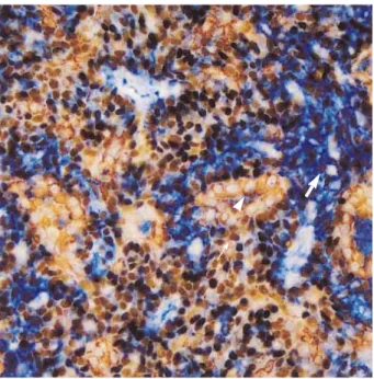 Fig. 5. Double marker analysis shows that nuclei of outer basal cells (arrow-head) of tubules are positive for p63 (brown color), and spindle shaped myoepithelial cells (arrow) are both positive for p63 (nucleus, brown color) and SMA (cytoplasm, reddish br