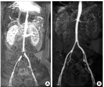 Fig. 3. (A) Preoperative angiography shows no visualization of supe- supe-rior mesenteric artery and left renal artery, a stenotic right renal artery, and a enlarged inferior mesenteric artery