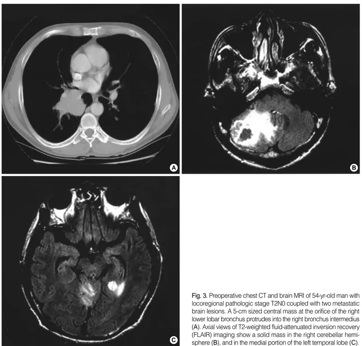 Fig. 3. Preoperative chest CT and brain MRI of 54-yr-old man with locoregional pathologic stage T2N0 coupled with two metastatic brain lesions